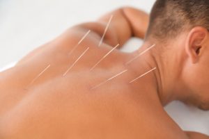 acupuncture -patient
