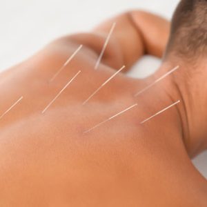 acupuncture -patient
